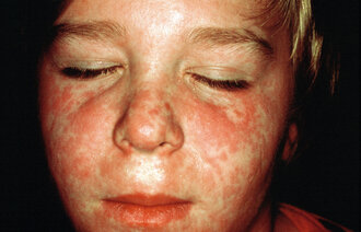 Bildet viser et barn med utslett i ansiktet forårsaket av meslinger