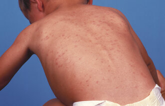 Bildet viser ryggen på et lite barn som har utslett som skyldes meslinger.