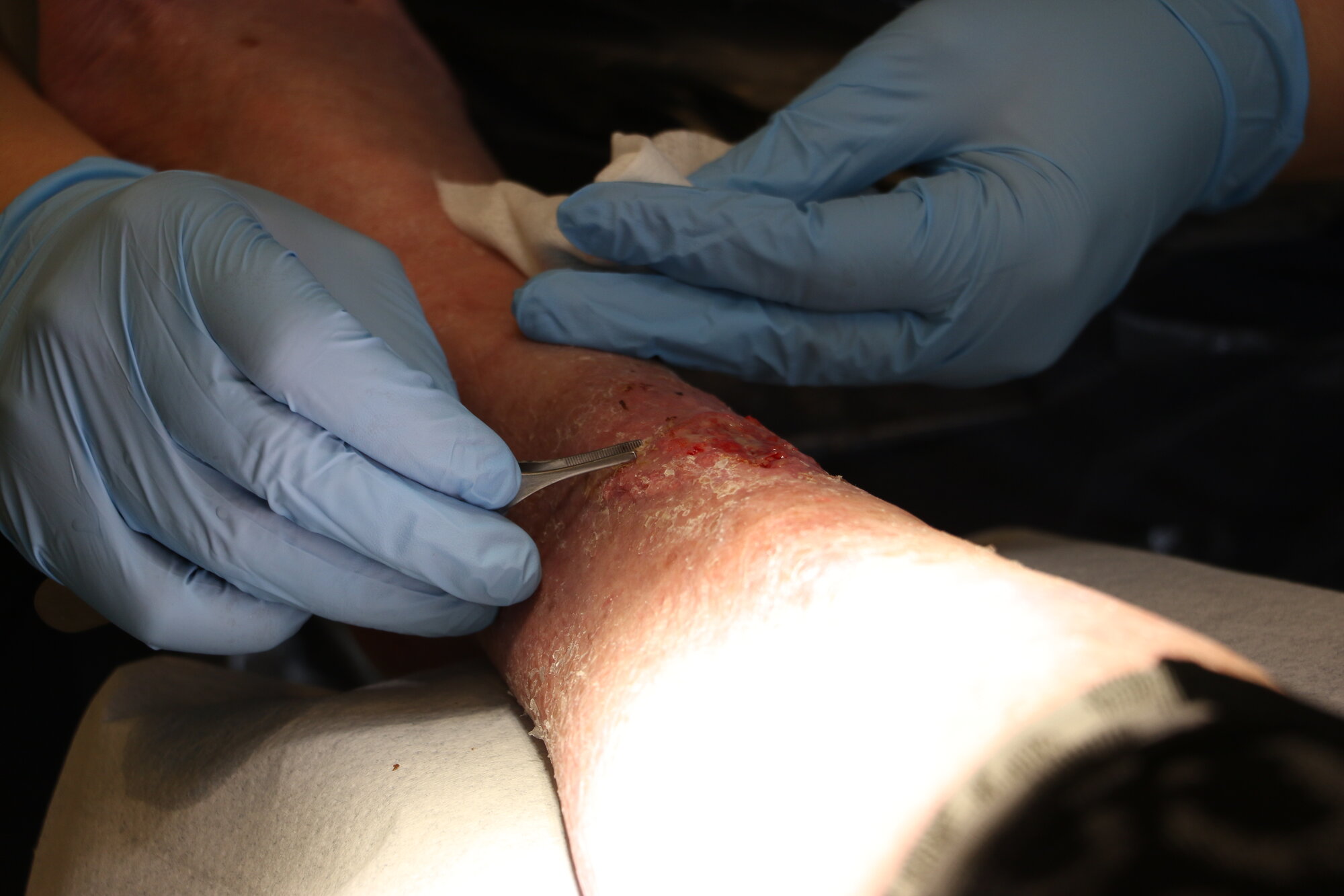 En sykepleier behandler et sår