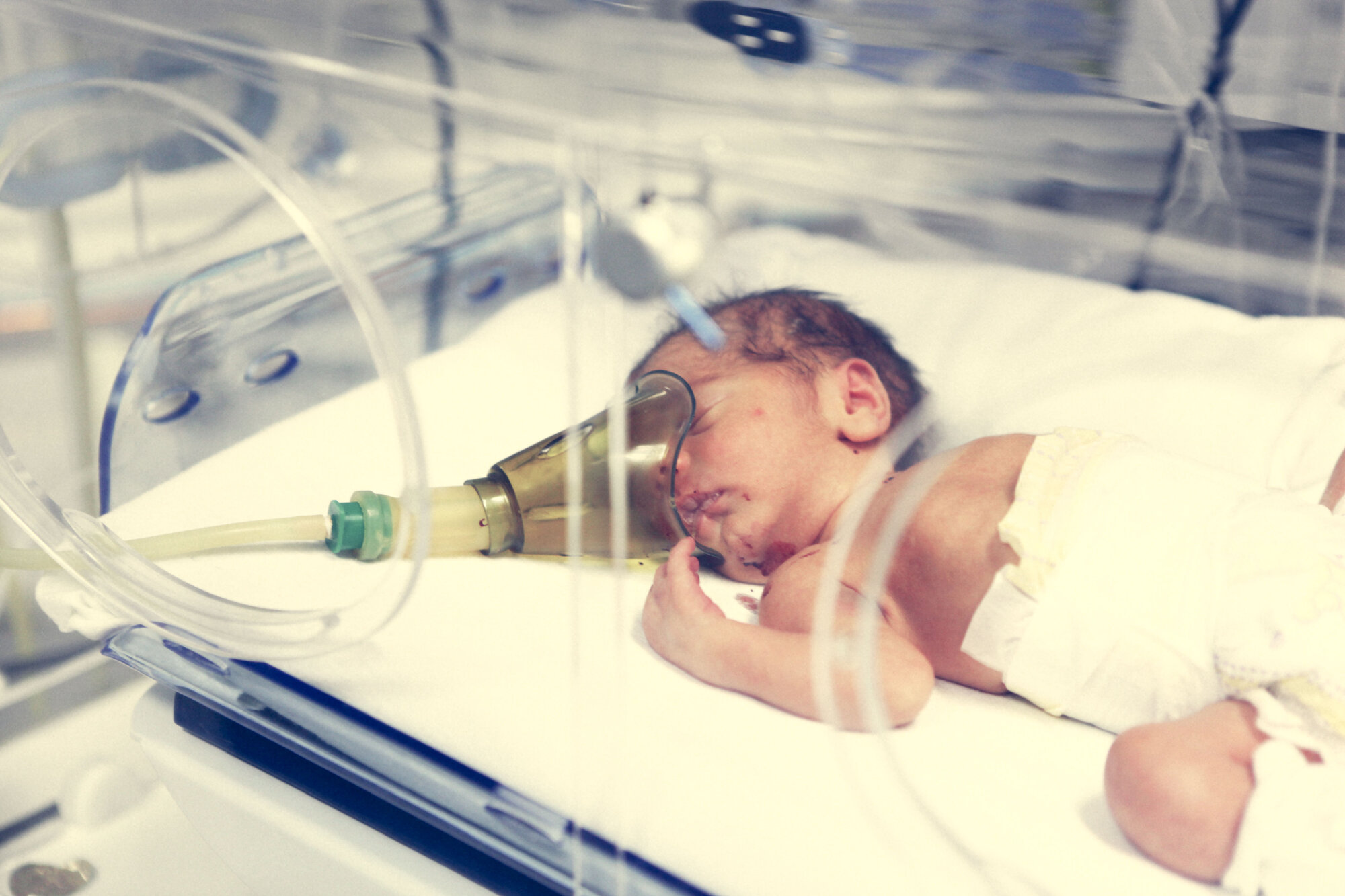 Новорожденный тяжело дышит. ИВЛ недоношенных новорожденных. Аппарат ИВЛ реанимация новорожденных. Асфиксия Новорожденные кювез. Асфиксия недоношенного ребенка.