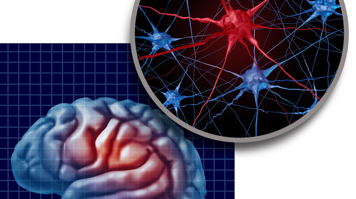 Bildet viser en illustrasjon av en hjerne med Parkinson sykdom