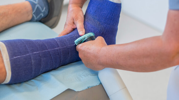 Bilde viser gipsing av bein