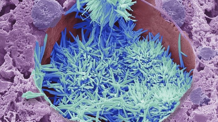 Bildet viser kolesterolkrystaller.