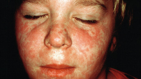 Bildet viser et barn med utslett i ansiktet forårsaket av meslinger