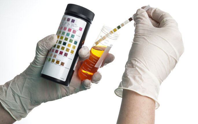 Hender som holder et glass med urin som skal undersøkes med en urinstiks