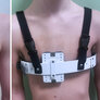 Bildet viser korsettbehandling ved pectus carinatum