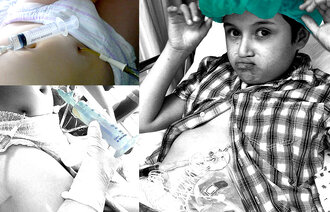 Oscar som ble behandlet hjemme i sykesengen og nær bilder av magen med teknisk utstyr.