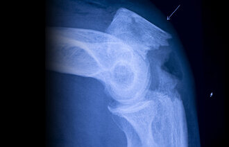 Bildet viser et røntgenbilde av et brudd.
