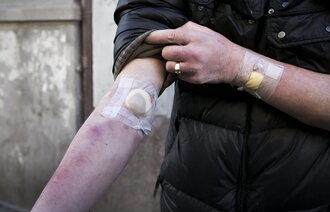 Bildet viser armen til en person som har injisert rusmidler i en lengre periode