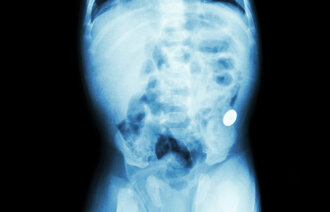 Bildet viser et røntgenbilde av kroppen til et spedbarn.
