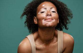 Bildet viser en ung kvinne med hudsykdommen vitiligo