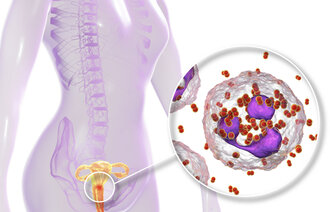 Bildet er en illustrasjon som viser gonoréinfeksjon hos en kvinne. 