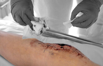 Bildet viser stell av sår.