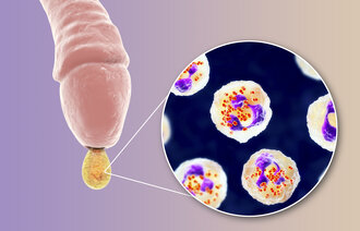 Illustrasjonen viser en penis med utflod og gonorebakterier.