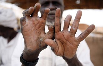 En eldre mann viser frem hender rammet av lepra.