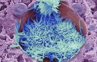 Bildet viser kolesterolkrystaller.