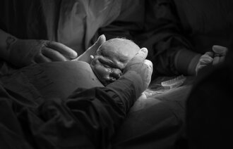 Bildet viser MAC-keisersnitt