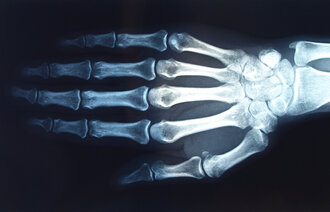 bildet viser røntgen av en hånd