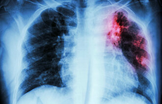 Bildet viser  røntgenbilde av lunger med tuberkulose øverst i venstre lunge
