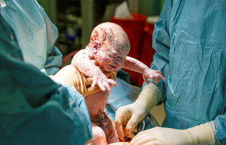 Bildet viser en baby som akkurat er født ved keisersnitt
