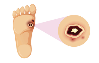 Illustrasjonen viser et diabetessår under foten som er forstørret opp.