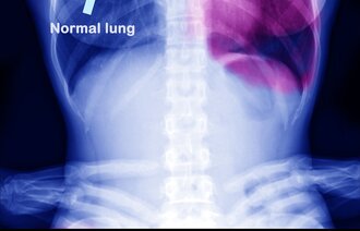 Røntgenbilde av lunger. En frisk lunge, og en lunge med kreftsvulst.