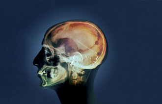 Bildet viser et røntgenbilde av et hode sett fra siden, der man kan se shunten inne i hodet.