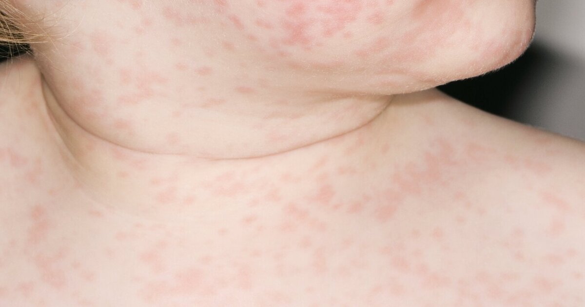 Small Red Bumps On Infants Body