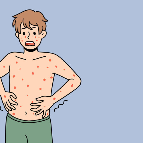 Illustrasjonen viser en mann med utslett på kroppen.