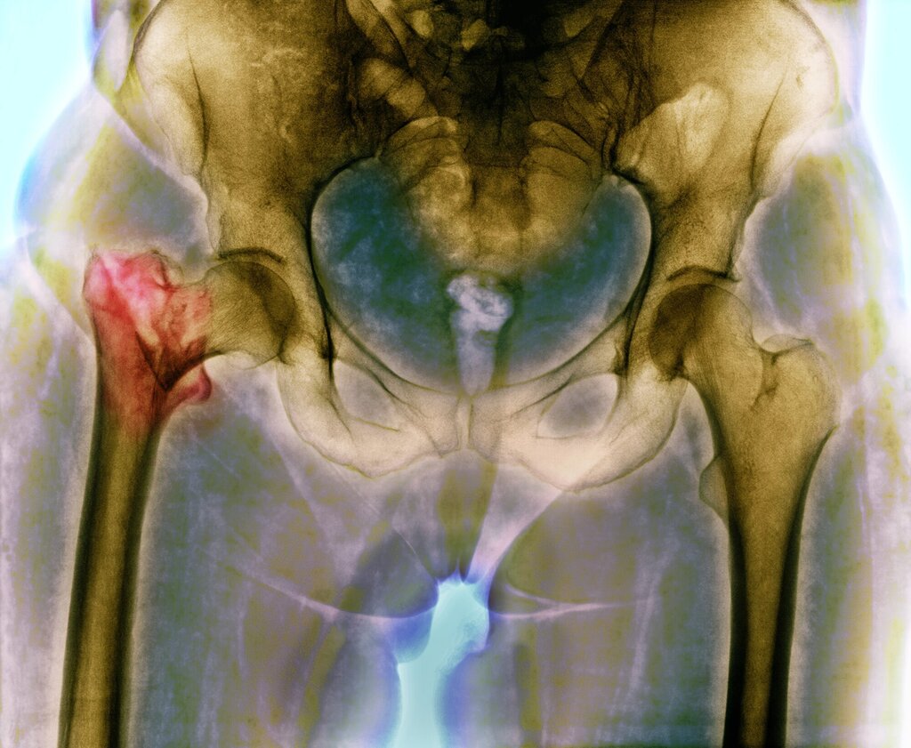 bildet viser et røntgen av hoftebrudd