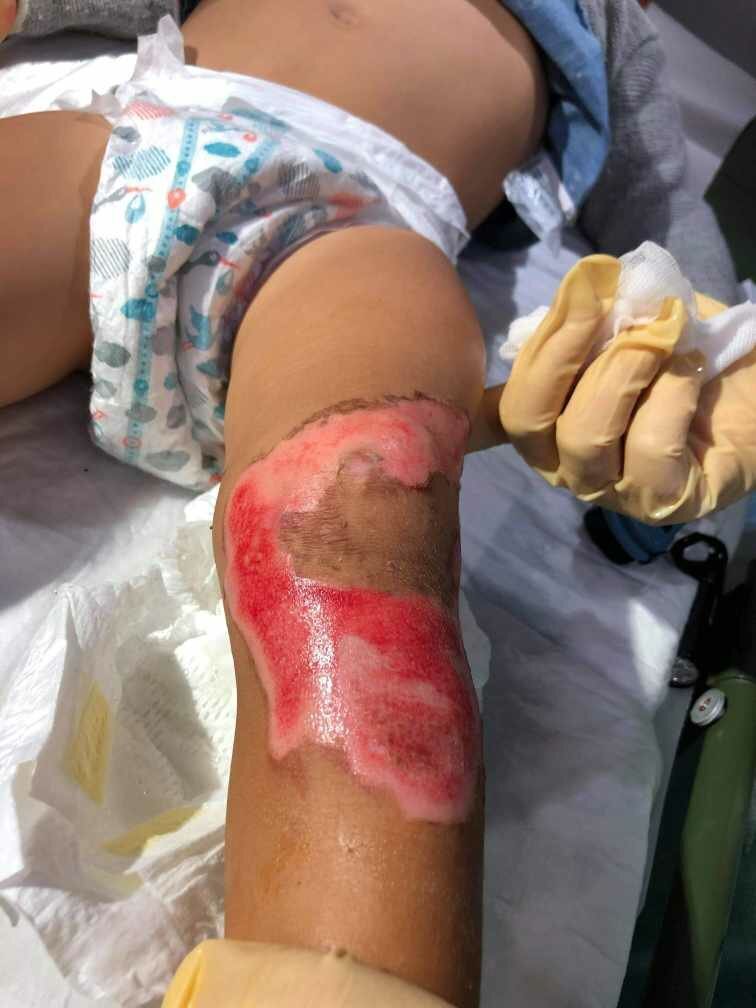 Bildet viser en brannskade på beinet til et lite barn.
