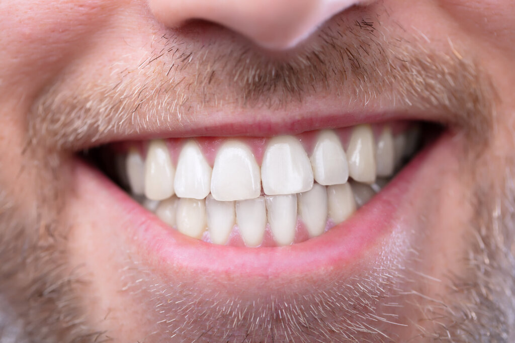 Bildet viser tenne til en mann som smiler