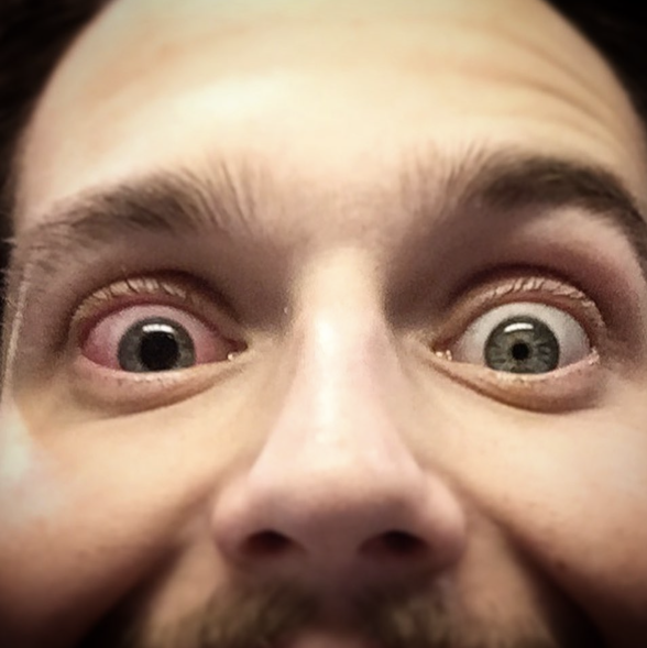 Bildet viser en mann som har to ulike pupiller.