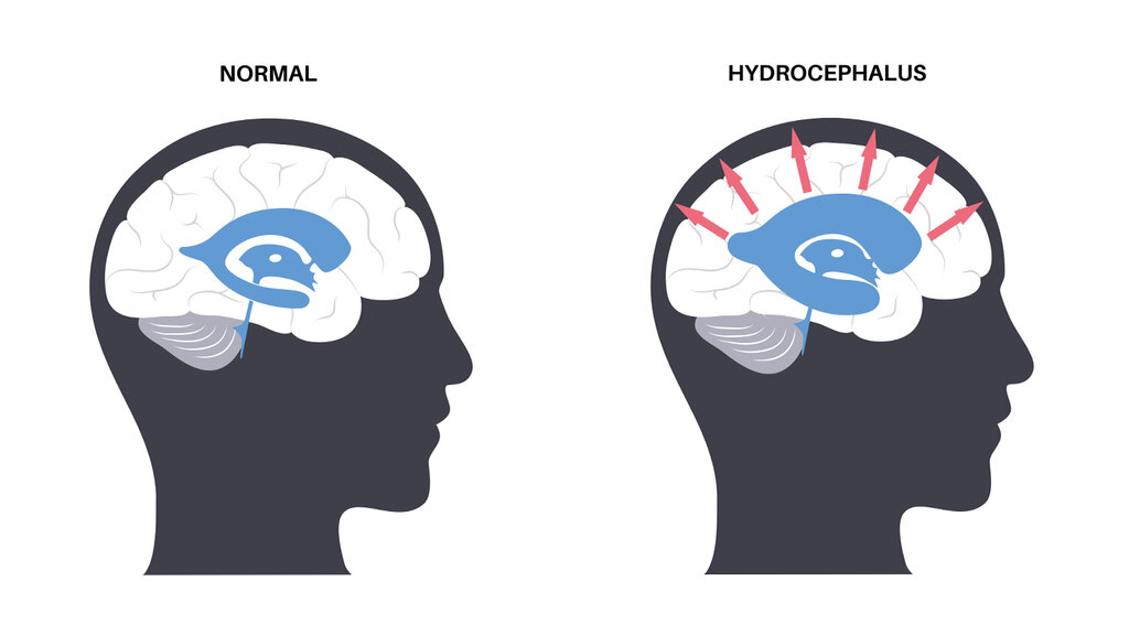Illustrasjonen viser et hode sett fra siden med en normal hjerne. Til høyre for den vises et hode fra siden med en hjerne som har hydrocefalus.