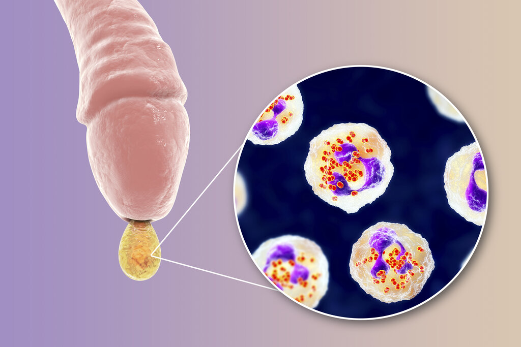 Illustrasjonen viser en penis med utflod og gonorebakterier.