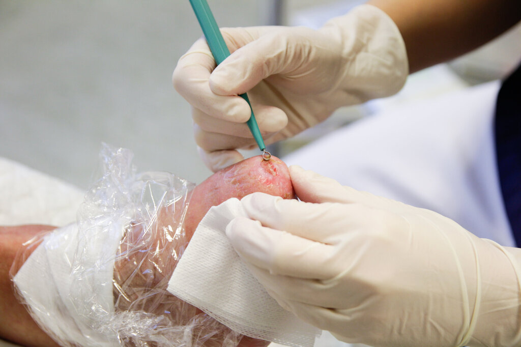 Bildet viser en curette som fjerner fibrin fra sårhuden