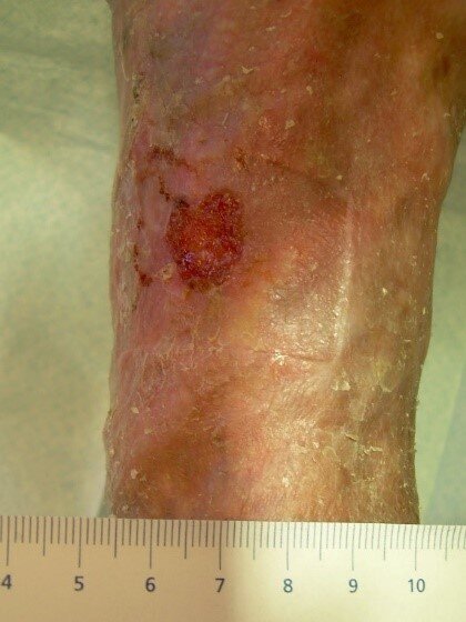 Bildet viser et sår på leggen hos eldre dame