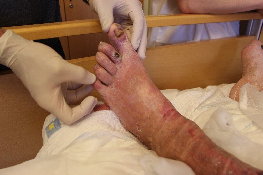 Bildet viser sår på føttene til en eldre dame