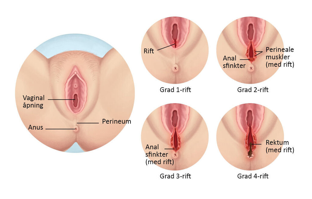 Illustrasjonen viser fire grader av vaginale rifter som kan oppstå i forbindelse med fødsel
