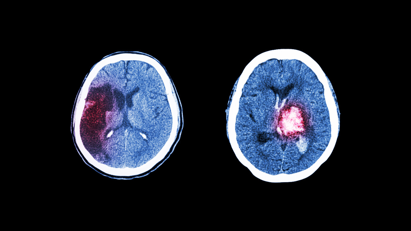 Bildet viser en CT-skanning av hjerneslag på grunn av cerebralt infarkt og blodpropp