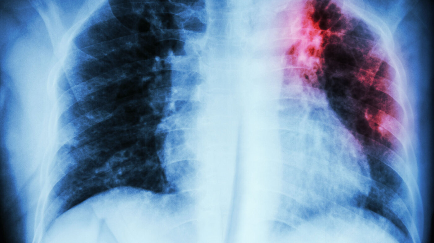 Bildet viser røntgenbilde av tuberkulose i øverste venstre lunge