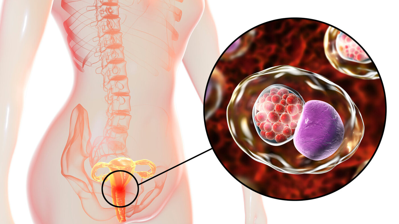 3D-illustrasjonen viser en kvinne med nærbilde av bakterien chlamydia trachomatis, som har infisert cellene i livmorhalsen