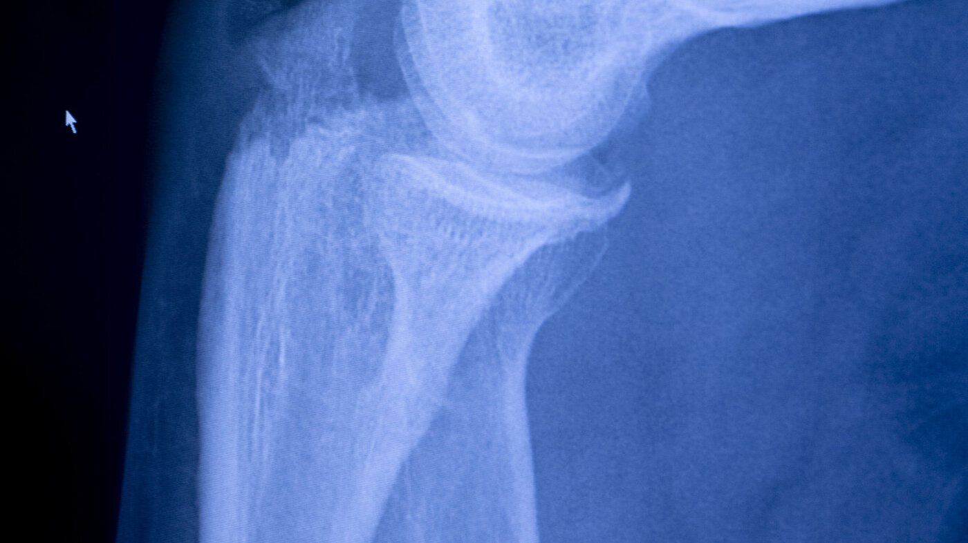 Bildet viser et røntgenbilde av et brudd.