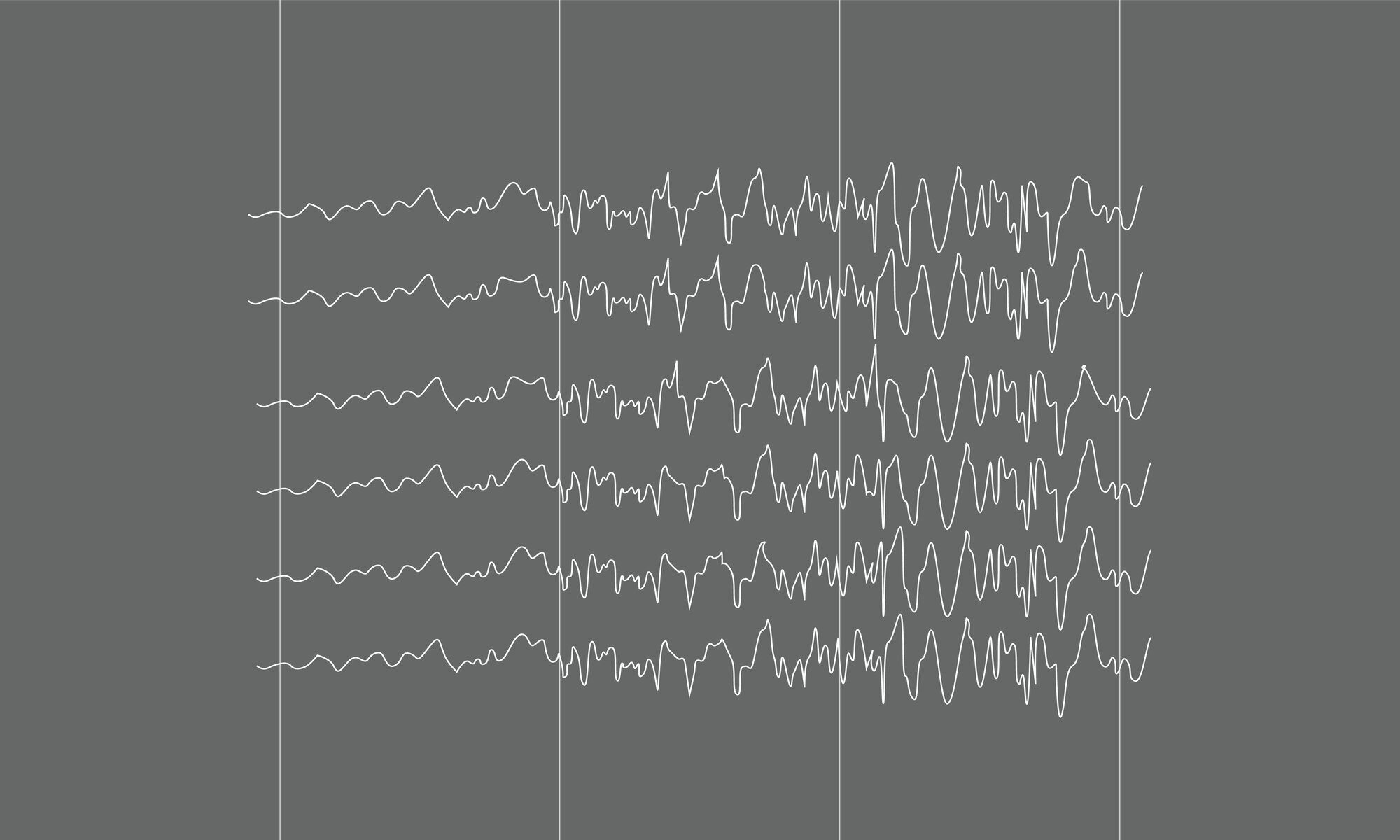Epilepsi Illustrasjonen viser hjernebølger gjengitt på eeg.