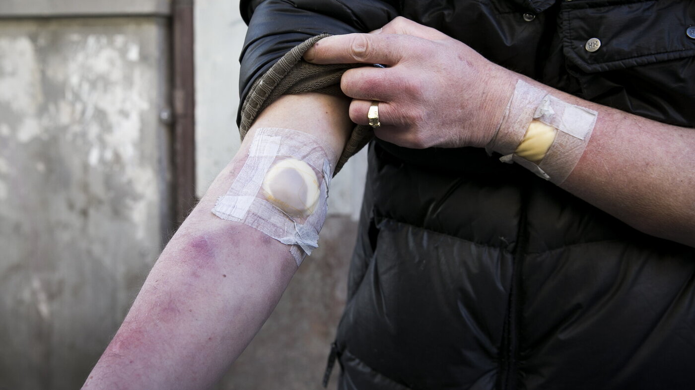 Bildet viser armen til en person som har injisert rusmidler i en lengre periode