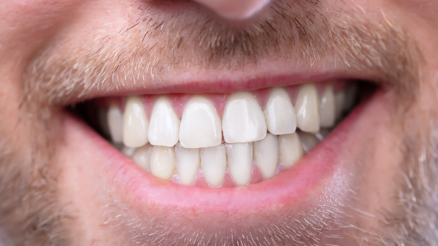 Bildet viser tenne til en mann som smiler