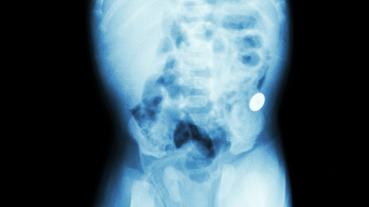 Bildet viser et røntgenbilde av kroppen til et spedbarn.