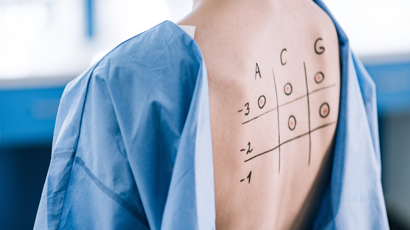 Bildet viser ryggen til en pasient påtegnet tall