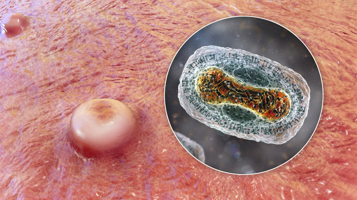 Bildet viser apekoppe-lesjon og innfelt virus.