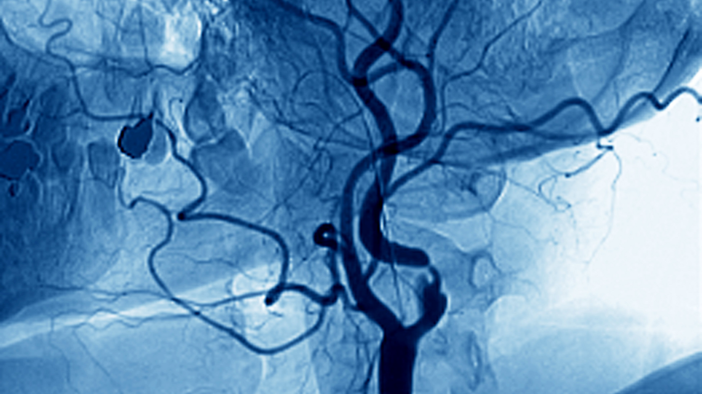 Bildet viser et angiogram av en innsnevret arterie i nakken.